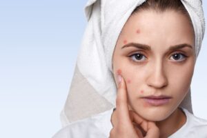 Acne - Reprodução do Canva
