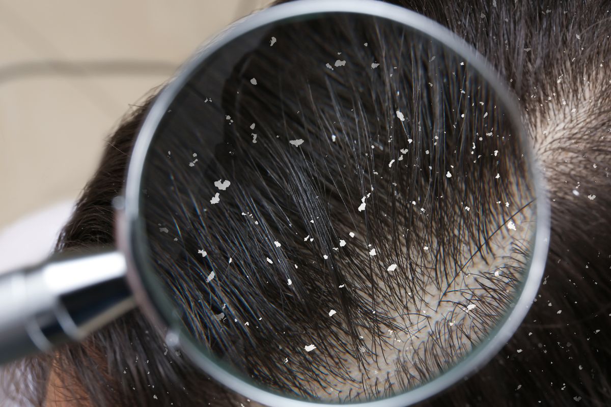 Caspa no cabelo - Reprodução Canva