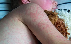 Tocantins confirma quatro casos de sarampo em pessoas não vacinadas; pacientes estão em isolamento