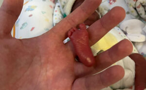 Tocantins realiza seminário para prevenir prematuridade e melhorar atenção neonatal; inscrições abertas