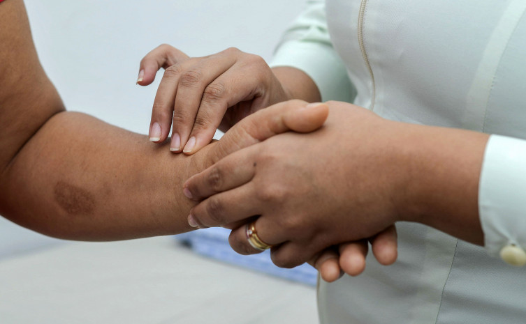 Mais de 800 casos de hanseníase acendem alerta no Tocantins e mobilizam ações de diagnóstico e prevenção