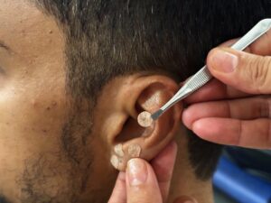 Para deixar o cigarro, pacientes usam auriculoterapia e tratamento registra 76,9% de adesão em Palmas